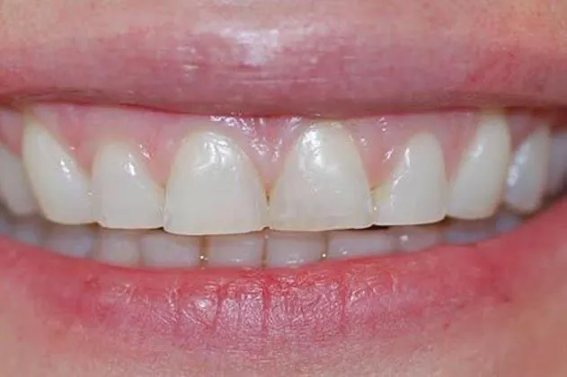 worn-down-teeth-from-grinding-before