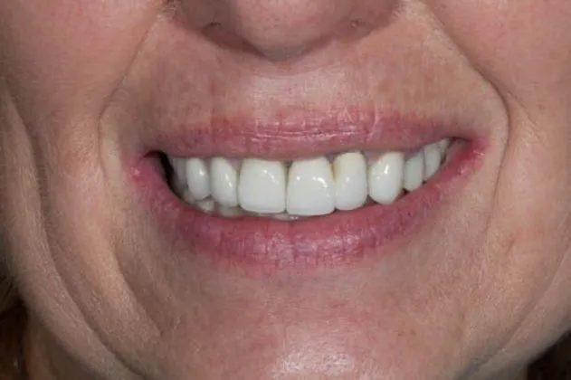 smile-makeover-case-01-after