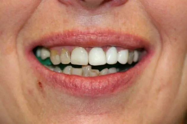 smile-makeover-case-01-before