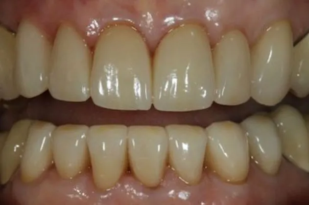 smile-makeover-case-02-after