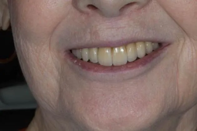 smile-makeover-case-03-after-teeth