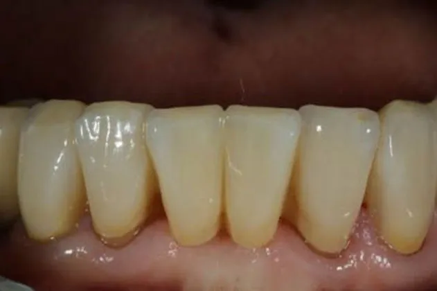 smile-makeover-case-03-after