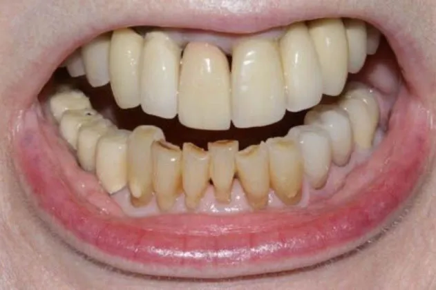 smile-makeover-case-03-before-teeth