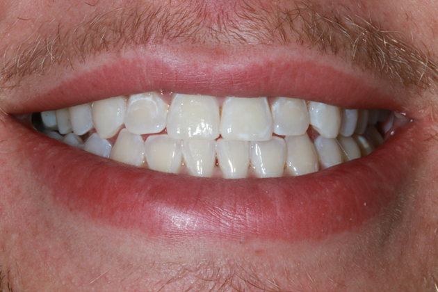 teeth-whitening-after-case-01