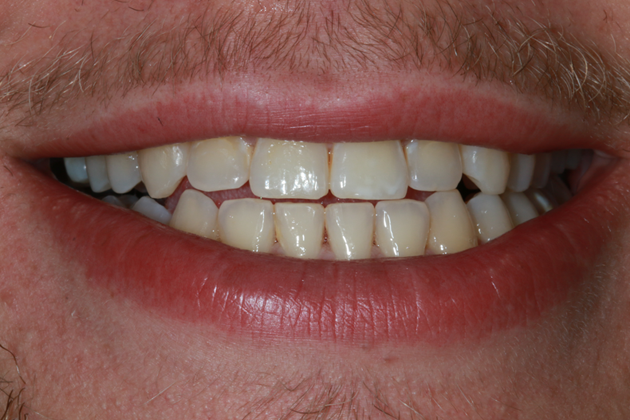 teeth-whitening-before-case-01