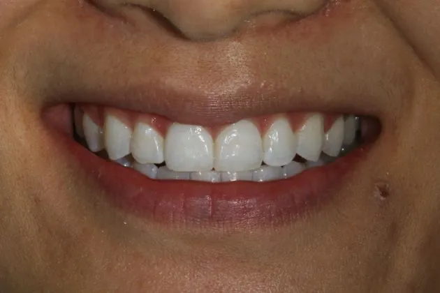 teeth-whitening-after-case-01
