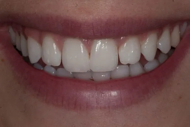 teeth-whitening-after-case-02