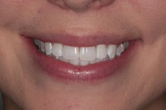 teeth-whitening-after-case-03