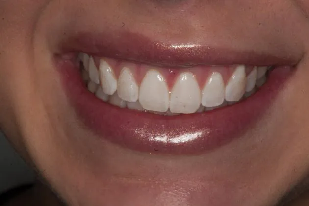 teeth-whitening-after-case-04