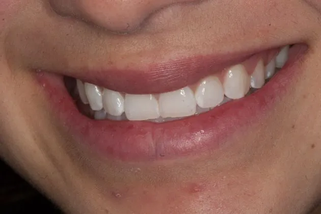 teeth-whitening-after-case-05