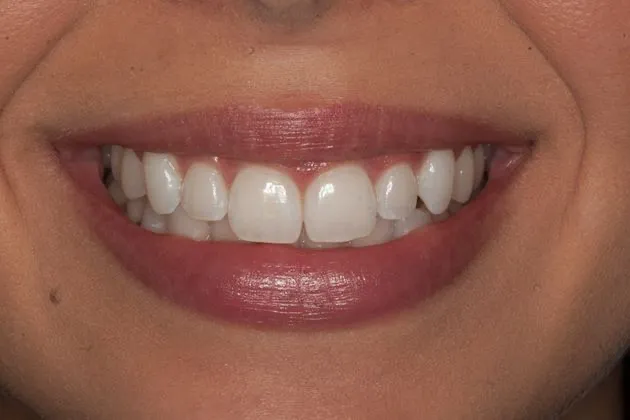 teeth-whitening-after-case-06