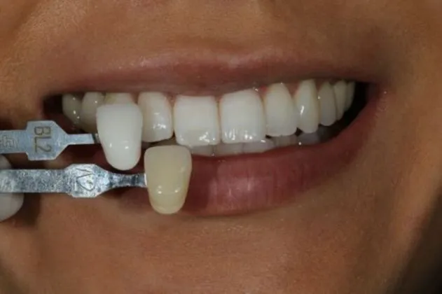 teeth-whitening-after-case-07-comparison-02