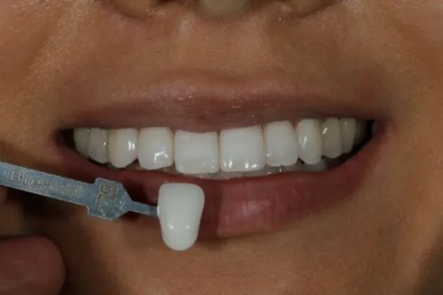 teeth-whitening-after-case-07-teeth
