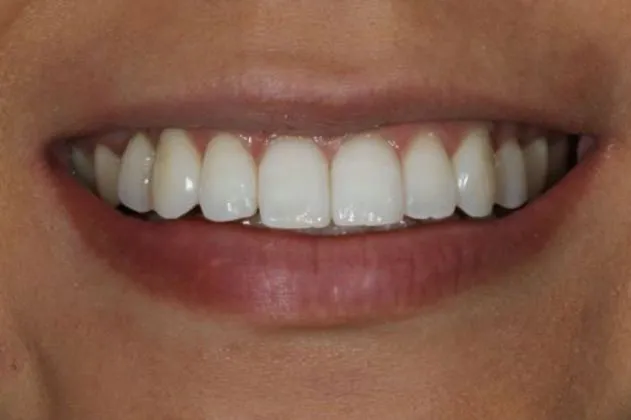 teeth-whitening-after-case-07