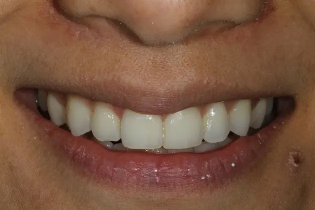teeth-whitening-before-case-01