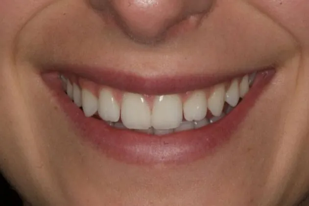 teeth-whitening-before-case-02