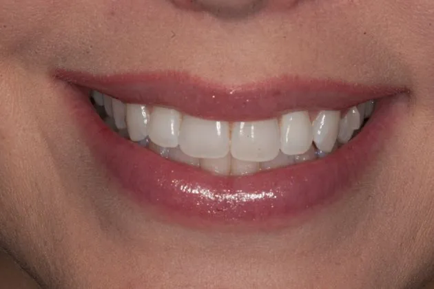 teeth-whitening-before-case-03
