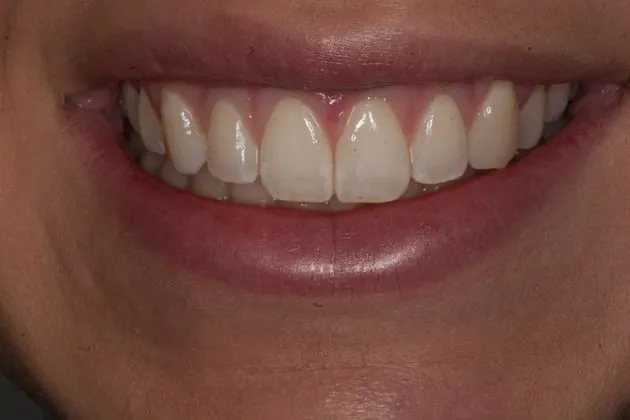 teeth-whitening-before-case-04