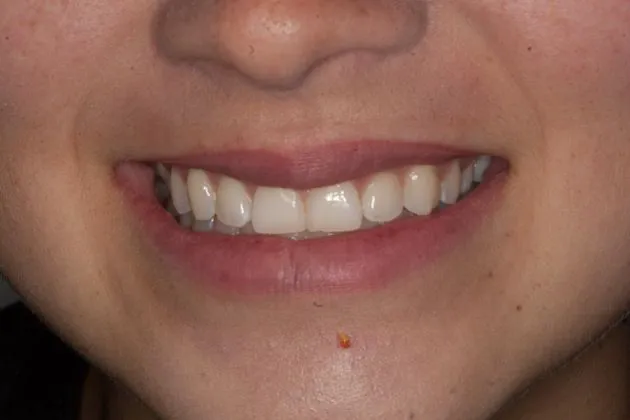 teeth-whitening-before-case-05