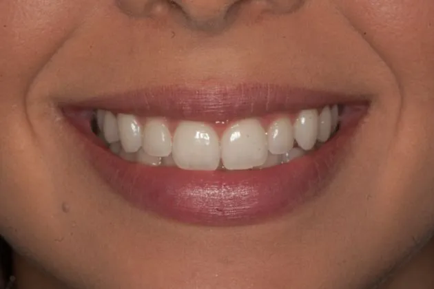 teeth-whitening-before-case-06