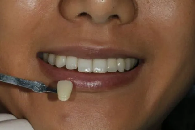 teeth-whitening-before-case-07-teeth
