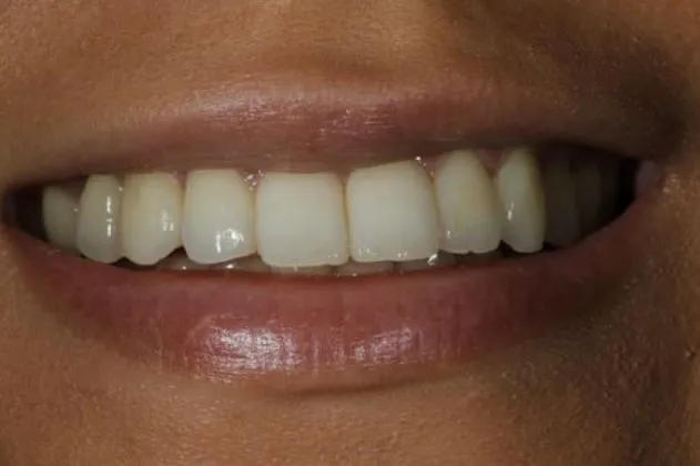 teeth-whitening-before-case-07